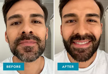 Mustache & Beard before & after